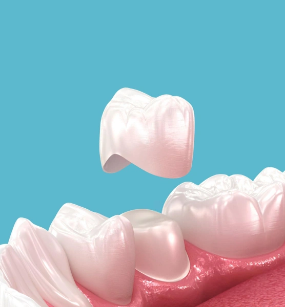 Dental crowns displayed on pink gum model against blue background, showing tooth restoration options.