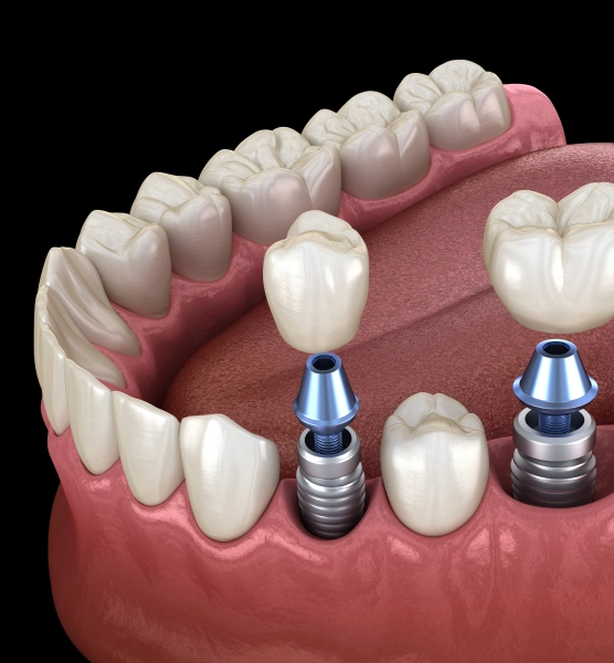 Dental implant diagram showing tooth replacement with implants and crowns in jawbone model.