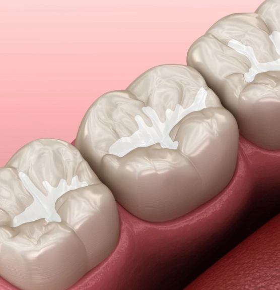 3D dental crowns rendered on pink gum model showing tooth restoration procedure.