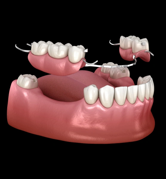 3D dental model showing implant placement, bridge restoration, and prosthetic teeth on pink gum base.
