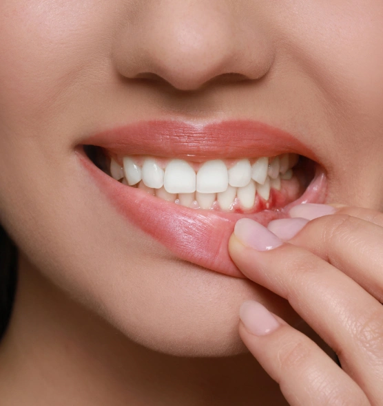 Close-up of person displaying healthy white teeth and pink gums with finger pointing to lower lip.