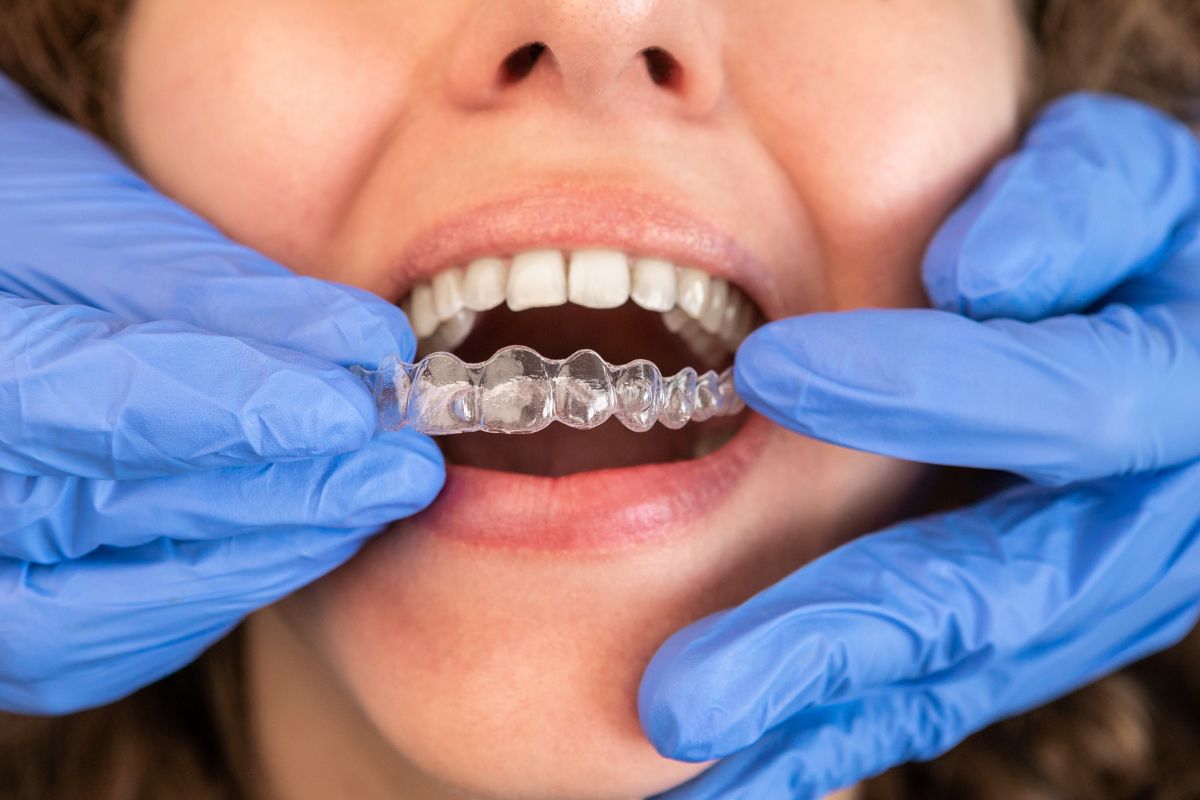 How Clear Aligners Improve Airway And Sleep Health
