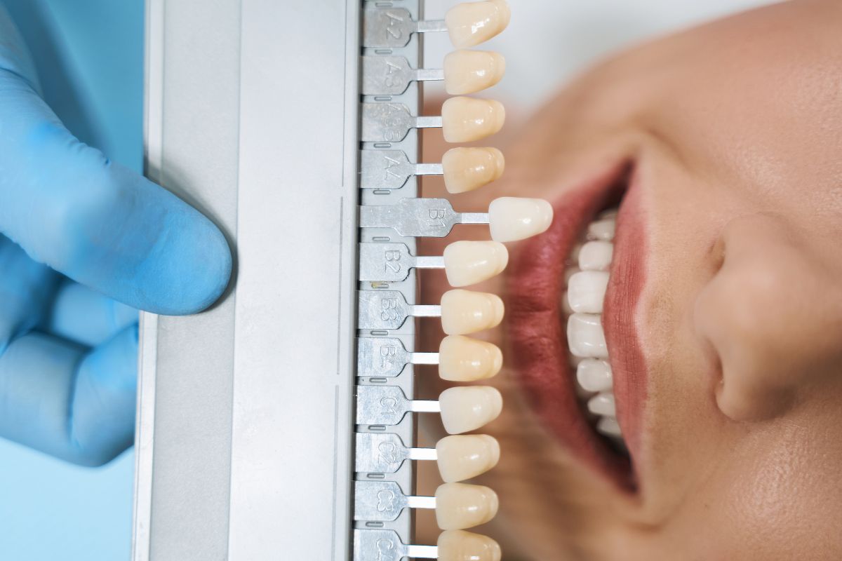Dental professional comparing tooth shade guide to patient's natural teeth color during examination.