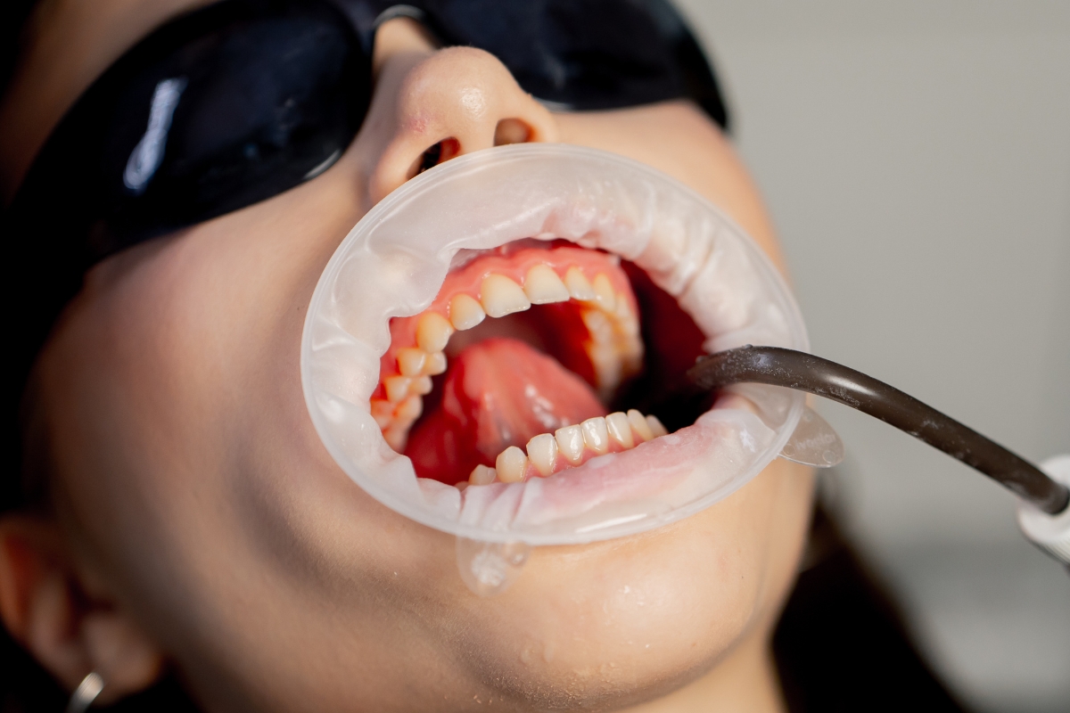 Trusted Dental Expert in Falcon What Sets Modern Care Apart