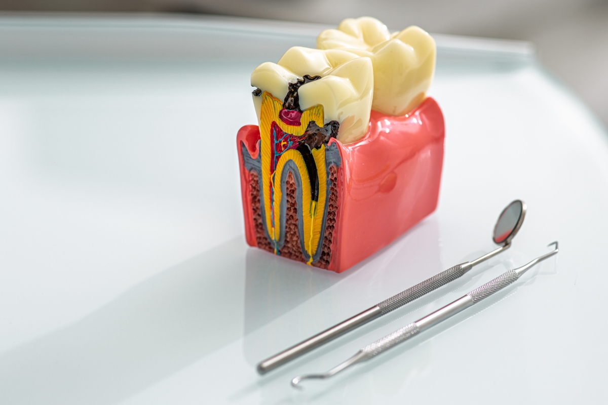 Tooth Cavity Treatments in Falcon